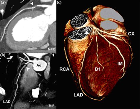 CT Scan: CT Coronary Angiography .